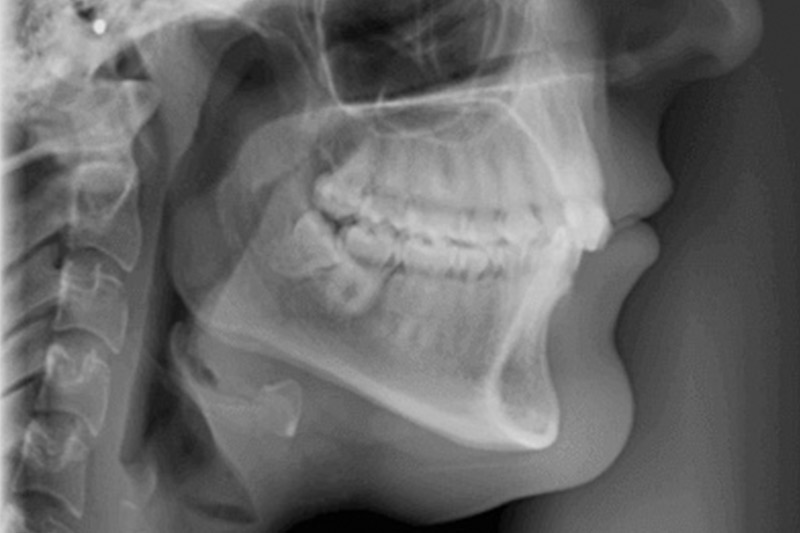 Cephalometrics in 